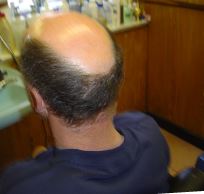 Hair Loss Solutions in Widnes