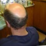 Frontal Fibrosing Alopecia in Walton