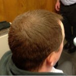 Hair Transplant and Cost in Liverpool