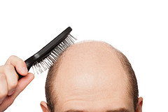 Hair Loss solution in Liverpool