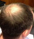 Alopecia in Southport